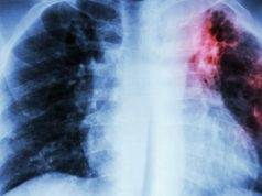 MITI&SALUTE/ Immigrati e malattie: il falso allarme tubercolosi